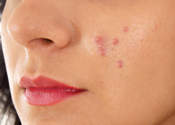 अगर आप भी हैं Blind Pimples से परेशान तो अपनाएं ये पांच आसान तरीके अगर आप भी हैं Blind Pimples से परेशान तो अपनाएं ये पांच आसान तरीके