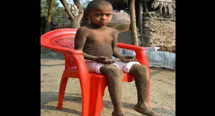 OMG ! धीरे- धीरे पत्थर का बनता जा रहा है मासूम, डॉक्टर भी हौरान OMG ! धीरे- धीरे पत्थर का बनता जा रहा है मासूम, डॉक्टर भी हौरान