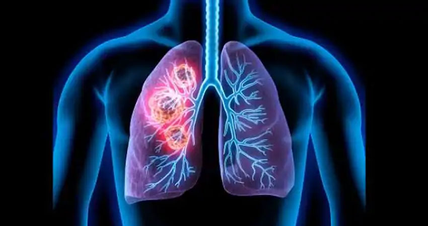 अगर दिख रहे ये लक्षण तो आप हो सकते हैं Lung Cancer के शिकार, ऐसे करें बचाव अगर दिख रहे ये लक्षण तो आप हो सकते हैं Lung Cancer के शिकार, ऐसे करें बचाव